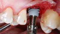 implant dentaire autoforant expansion osseuse