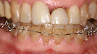 traction orthodontique